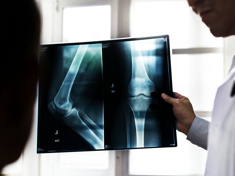 A doctor reviewing a knee X-ray with a patient